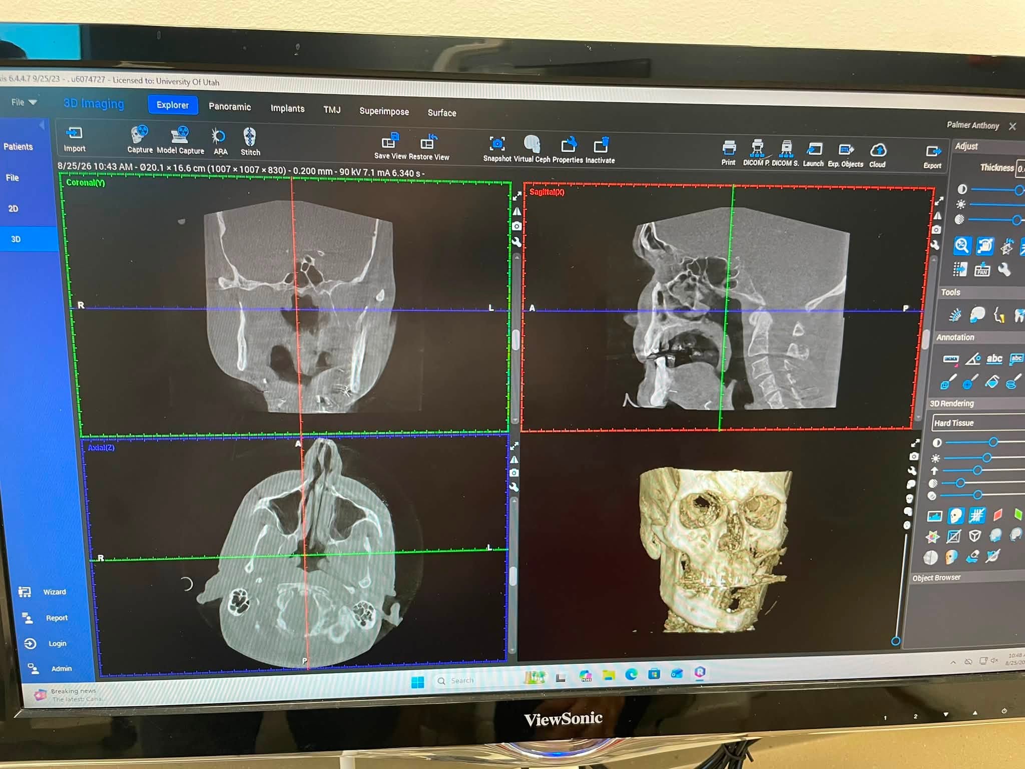 CT imaging of Tony's jaw and skull