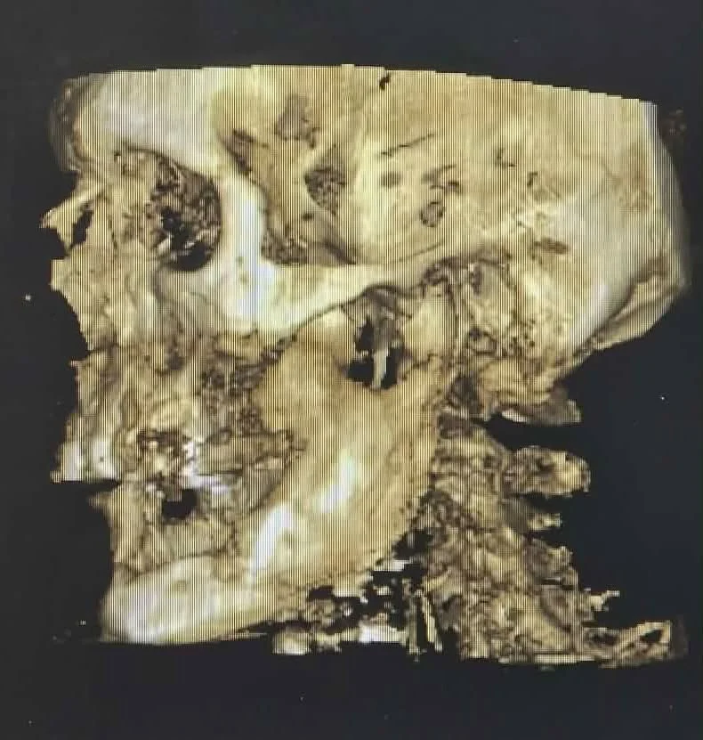 Side view of Tony's skull imaging