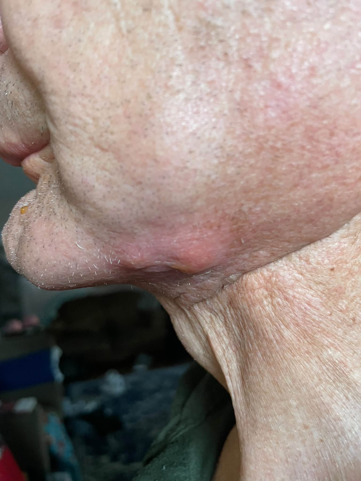Side view of Tony's head and jaw
